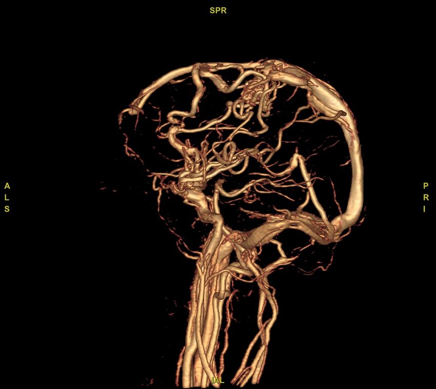 Cerebral arteriovenous malformation (Radiopaedia 61964-70029 VRT 3).jpg