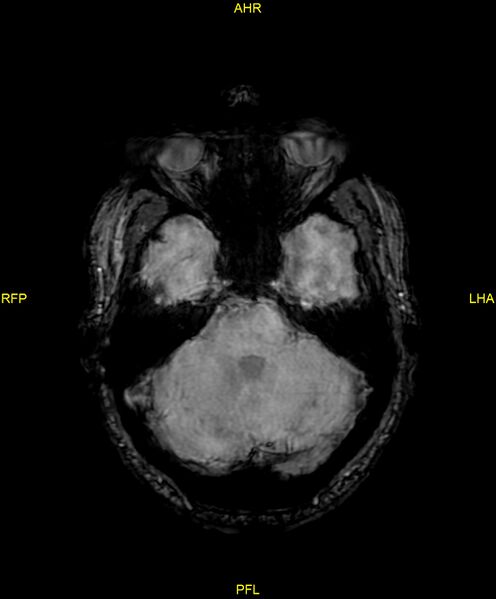 File:Cerebral autosomal dominant arteriopathy with subcortical infarcts and leukoencephalopathy (CADASIL) (Radiopaedia 86108-102054 Axial SWI 33).jpg