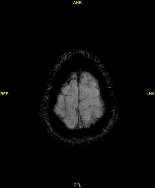 File:Cerebral autosomal dominant arteriopathy with subcortical infarcts and leukoencephalopathy (CADASIL) (Radiopaedia 86108-102054 Axial SWI 98).jpg