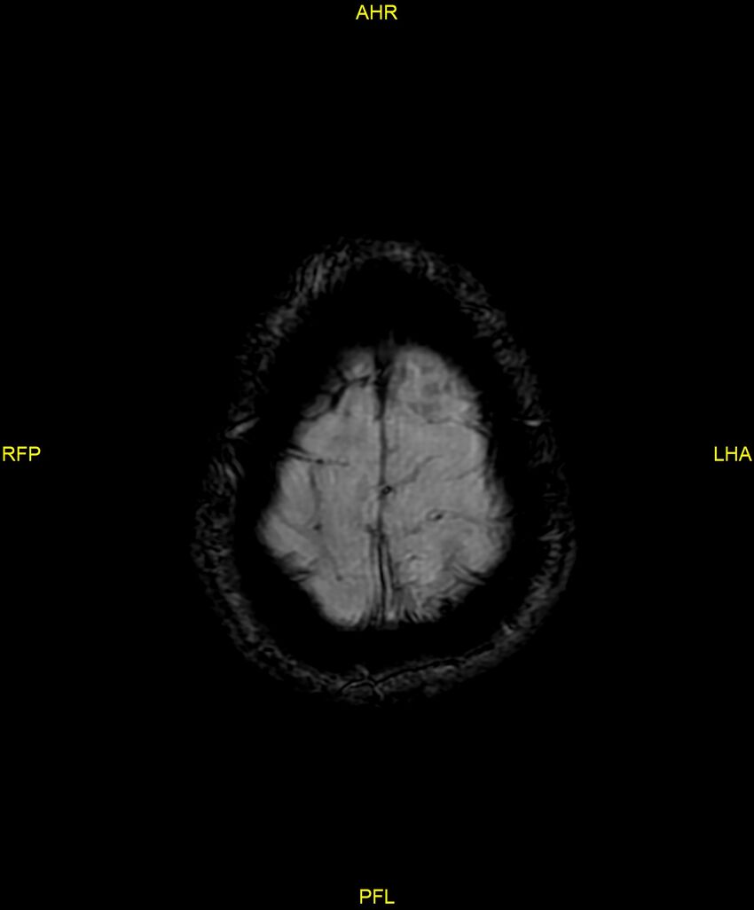 Cerebral autosomal dominant arteriopathy with subcortical infarcts and leukoencephalopathy (CADASIL) (Radiopaedia 86108-102054 Axial SWI 98).jpg