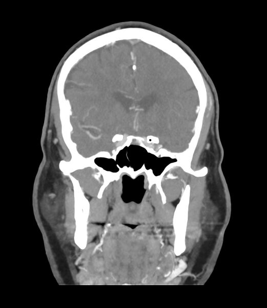 File:Cerebral dural venous sinus thrombosis (Radiopaedia 86514-102576 B 22).jpg