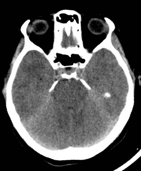File:Cerebral edema due to severe hyponatremia (Radiopaedia 89826-106937 Axial non-contrast 29).jpg