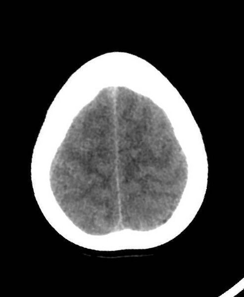 File:Cerebral edema due to severe hyponatremia (Radiopaedia 89826-106937 Axial non-contrast 80).jpg