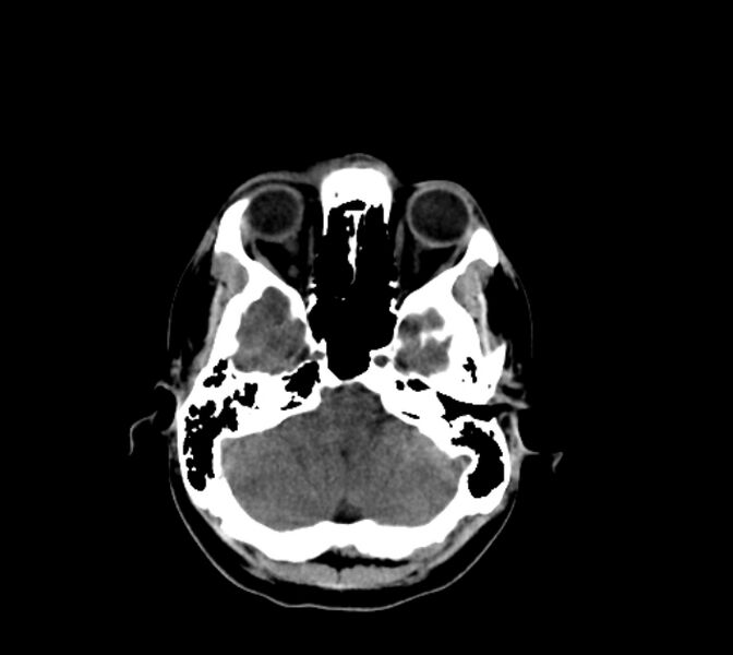 File:Cerebral fat embolism (Radiopaedia 37510-39362 Axial non-contrast 9).jpg