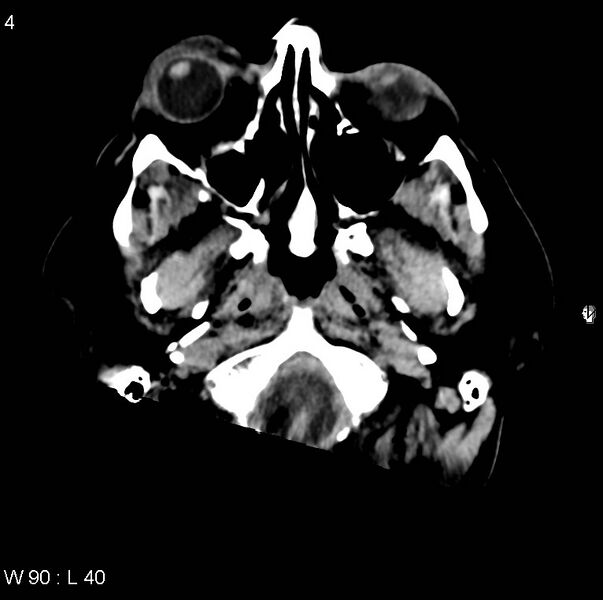 File:Cerebral hemorrhagic contusion with subdural and subarachnoid hemorrhage (Radiopaedia 10680-11146 Axial non-contrast 1).jpg