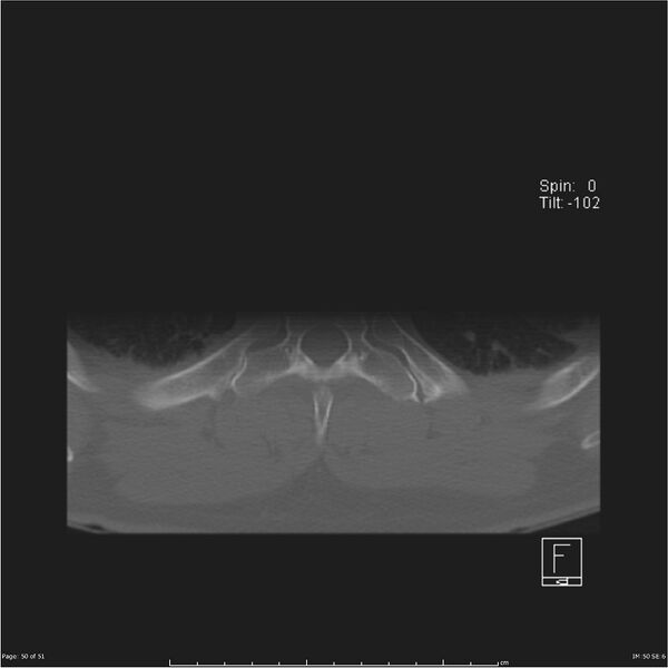 File:Cerebral hemorrhagic contusions and cervical spine fractures (Radiopaedia 32865-33841 C 50).jpg