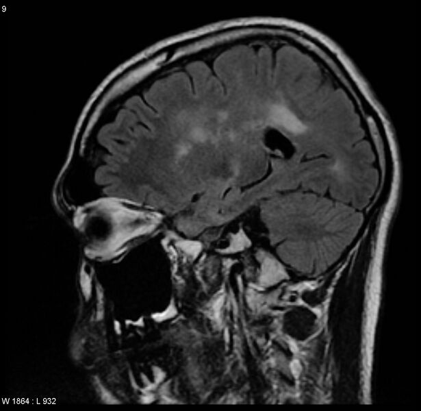 File:Cerebral vasculitis (Radiopaedia 5131-6923 Sagittal FLAIR 2).jpg