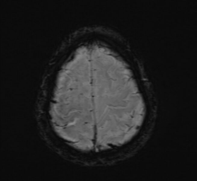 File:Cerebral venous thrombosis (Radiopaedia 71207-81504 Axial SWI 46).jpg