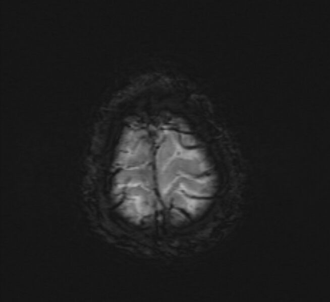 File:Cerebral venous thrombosis (Radiopaedia 71207-81504 Axial SWI 51).jpg