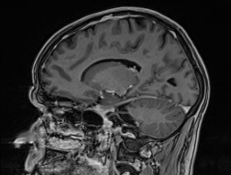 File:Cerebral venous thrombosis (Radiopaedia 71207-81504 Sagittal T1 C+ 38).jpg