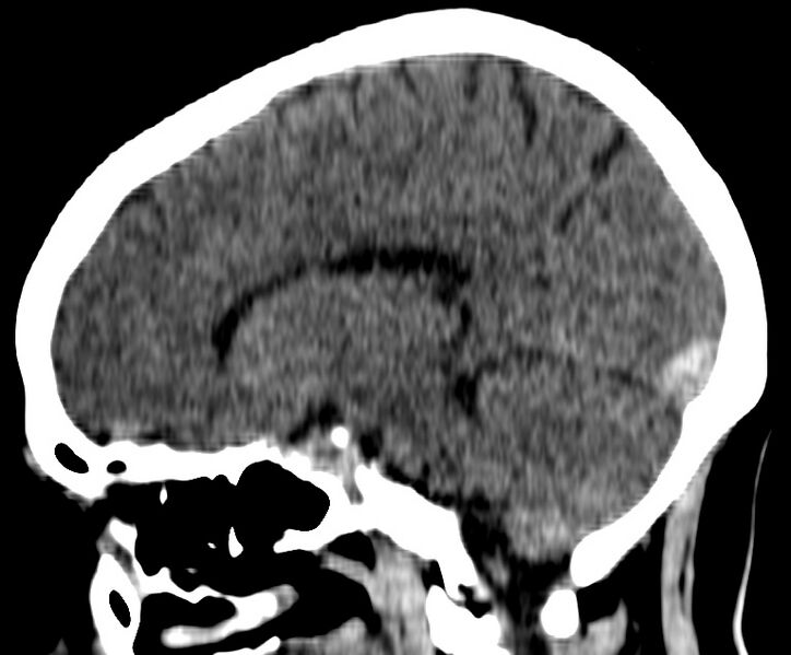 File:Cerebral venous thrombosis - CT only (Radiopaedia 41031-43778 B 22).jpg