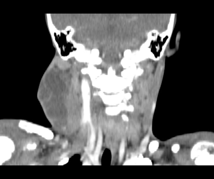 File:Cervical cystic lymphangioma (Radiopaedia 63655-72332 Coronal + contrast 24).jpg