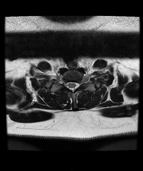 File:Cervical disc prolapse (Radiopaedia 80258-93598 Axial T2 73).jpg