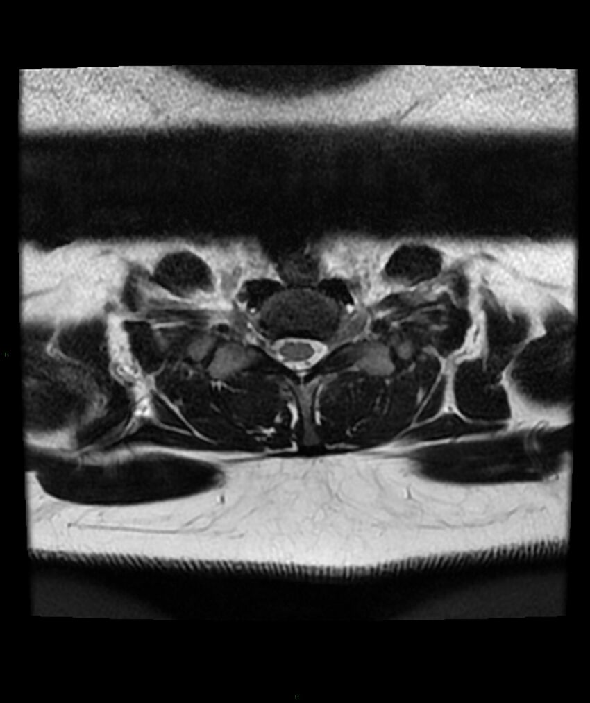 Cervical disc prolapse (Radiopaedia 80258-93598 Axial T2 73).jpg