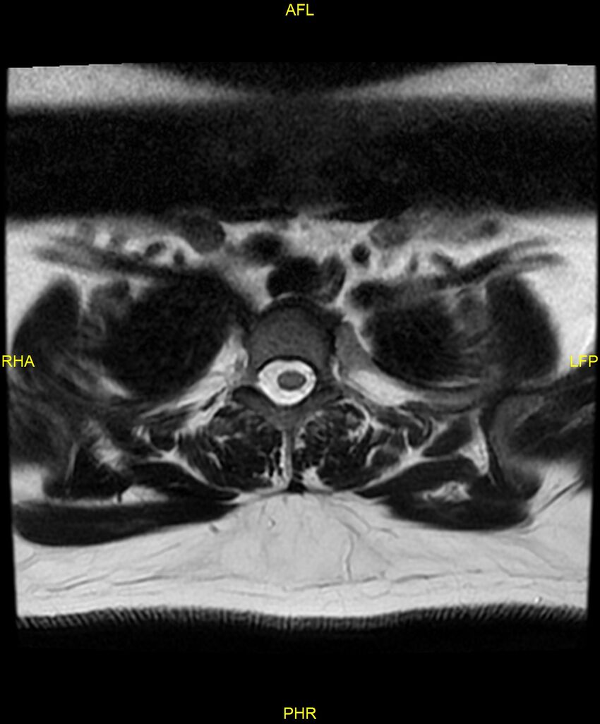 Cervical disc protrusion (Radiopaedia 87147-103415 Axial T2 90).jpg
