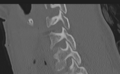 Cervical disc replacement (Radiopaedia 37383-39205 Sagittal bone window 49).png