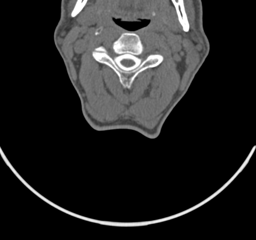 Cervical dural CSF leak on MRI and CT treated by blood patch (Radiopaedia 49748-54996 B 26).png