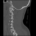 Cervical flexion teardrop fracture with cord hemorrhage (Radiopaedia 32497-33454 Sagittal bone window 32).jpg