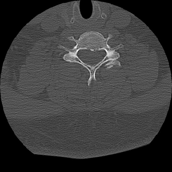 File:Cervical fracture and dislocation with locked facet (Radiopaedia 31837-32780 Axial bone window 9).jpg