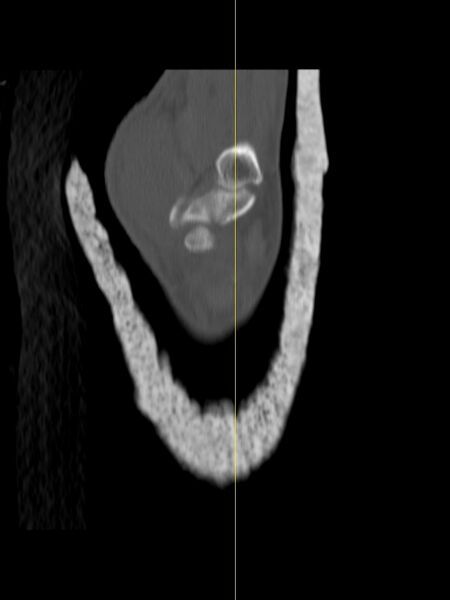 File:Chauffeur's (Hutchinson) fracture (Radiopaedia 58043-65079 Sagittal bone window 19).jpg