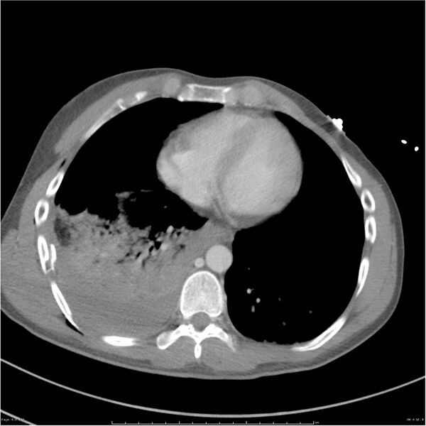File:Chest and abdomen multi-trauma (Radiopaedia 26294-26426 bone window 6).jpg
