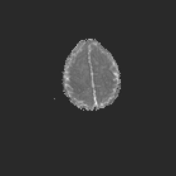 File:Chiari III malformation with occipital encephalocele (Radiopaedia 79446-92559 Axial ADC 19).jpg