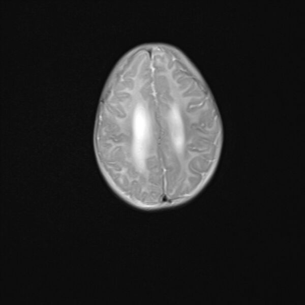 File:Chiari III malformation with occipital encephalocele (Radiopaedia 79446-92559 Axial T2 20).jpg