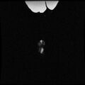 Chiari II malformation with spinal meningomyelocele (Radiopaedia 23550-23652 Coronal 3D myelogram 33).jpg