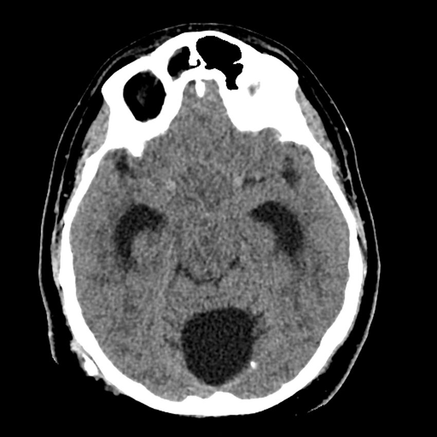 Chiasmatic-hypothalamic juvenile pilocytic astrocytoma (Radiopaedia 78533-91237 Axial non-contrast 23).jpg