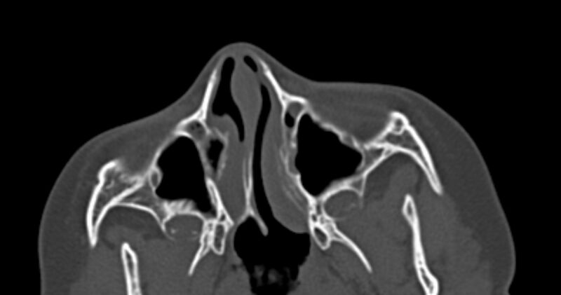 File:Choanal atresia (Radiopaedia 51295-56972 Axial bone window 21).jpg
