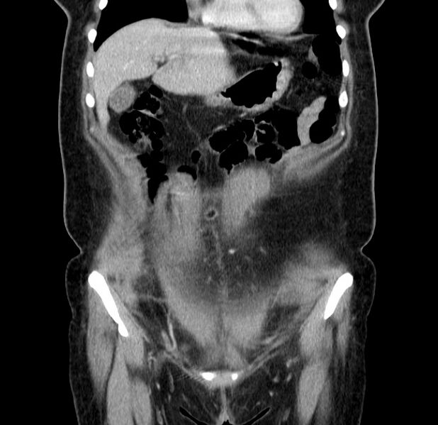 File:Choledocholithiasis on CT and MRI (Radiopaedia 24825-25087 C 14).jpg