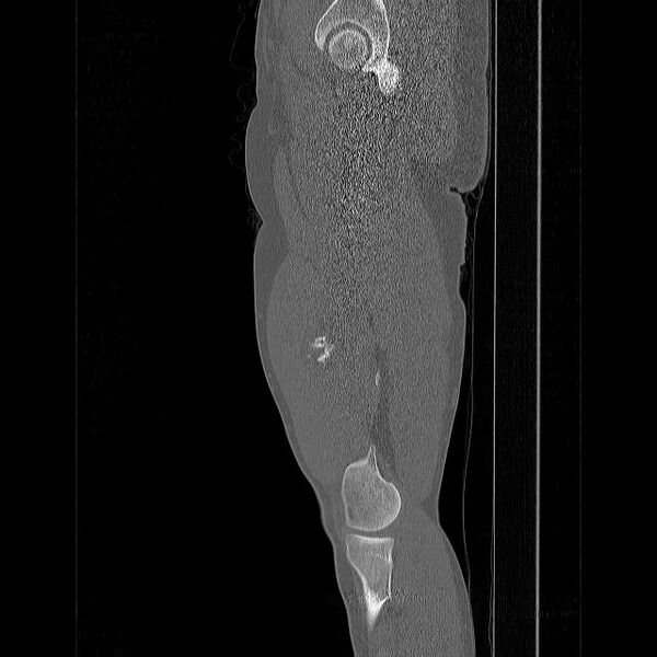 File:Chondrosarcoma arising from exostosis (Radiopaedia 59996-67507 Sagittal bone window 17).jpg