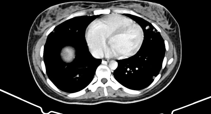 File:Choriocarcinoma liver metastases (Radiopaedia 74768-85766 A 14).jpg