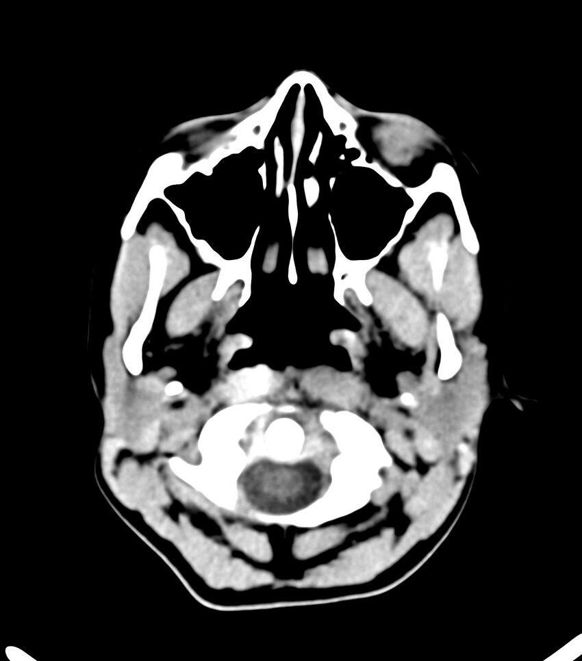 Choroid plexus carcinoma (Radiopaedia 91013-108552 Axial non-contrast 5).jpg
