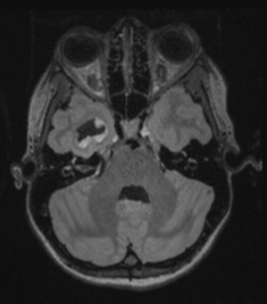 File:Choroid plexus carcinoma (Radiopaedia 91013-108553 Axial FLAIR C+ 98).jpg