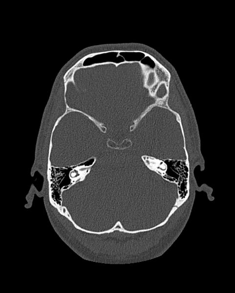 File:Chronic maxillary sinusitis caused by a foreign body (Radiopaedia 58521-65676 Axial bone window 265).jpg