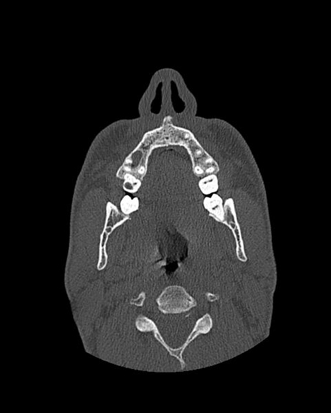 File:Chronic maxillary sinusitis caused by a foreign body (Radiopaedia 58521-65676 Axial bone window 30).jpg