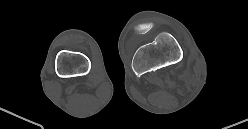 File:Chronic osteomyelitis (with sequestrum) (Radiopaedia 74813-85822 Axial non-contrast 173).jpg