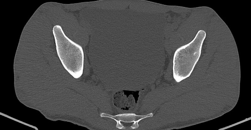 File:Chronic osteomyelitis (with sequestrum) (Radiopaedia 74813-85822 Axial non-contrast 25).jpg