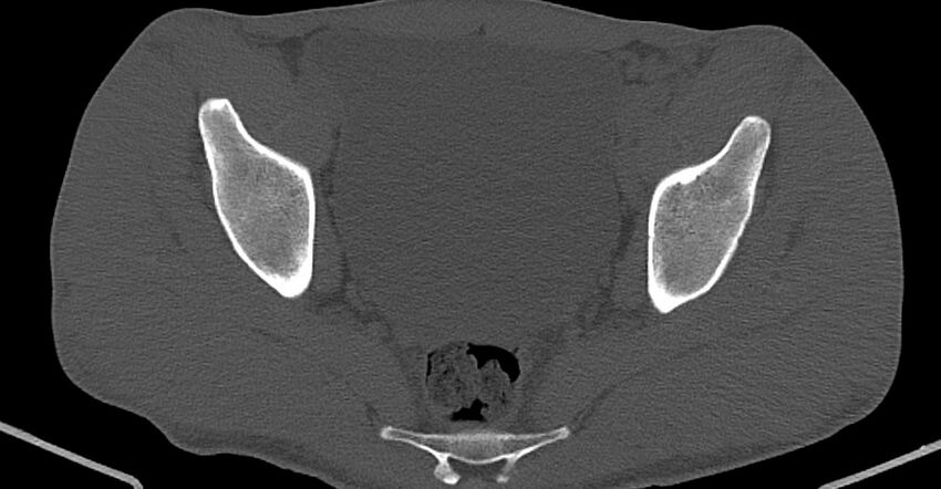 Chronic osteomyelitis (with sequestrum) (Radiopaedia 74813-85822 Axial non-contrast 26).jpg