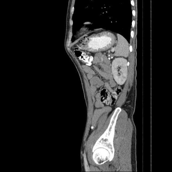 File:Chronic pancreatitis (Radiopaedia 21022-20949 D 5).jpg