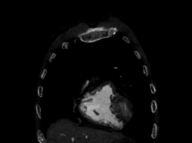 File:Chronic pulmonary embolism (Radiopaedia 91241-108843 A 9).jpg