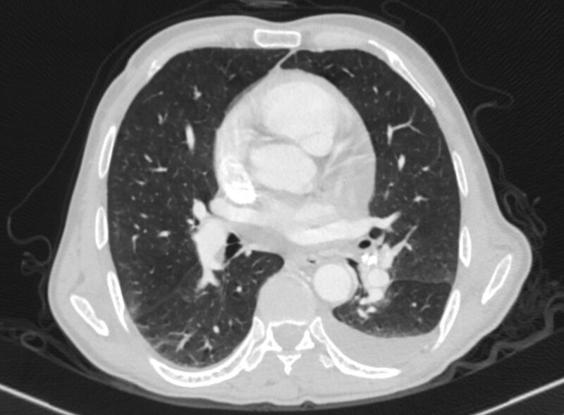 File:Chronic pulmonary embolism with bubbly consolidation (Radiopaedia 91248-108850 Axial lung window 86).jpg