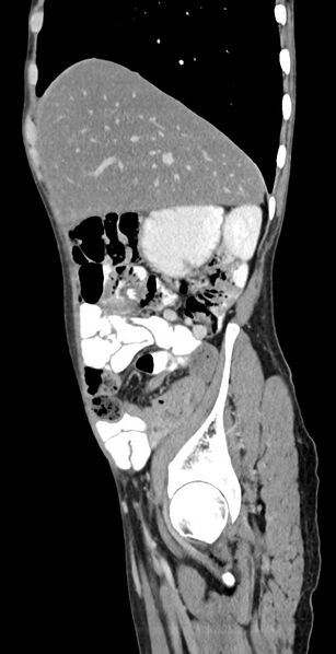 File:Chronic small bowel volvulus (Radiopaedia 75224-86322 C 112).jpg