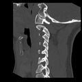 Clay-shoveler fracture (Radiopaedia 22568-22590 Sagittal bone window 33).jpg