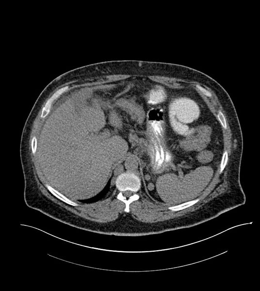 File:Closed-loop small bowel obstruction-internal hernia (Radiopaedia 78439-91096 Axial non-contrast 36).jpg