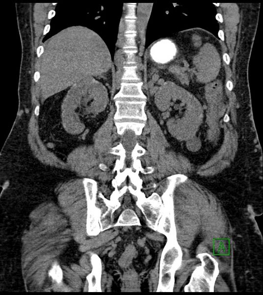 File:Closed-loop small bowel obstruction-internal hernia (Radiopaedia 78439-91096 Coronal non-contrast 72).jpg