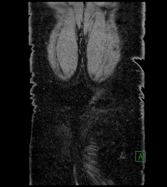 File:Closed-loop small bowel obstruction-internal hernia (Radiopaedia 78439-91096 Coronal non-contrast 97).jpg