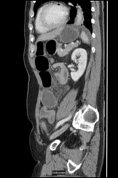 File:Closed loop bowel obstruction and ischemia (Radiopaedia 86959-103180 C 19).jpg