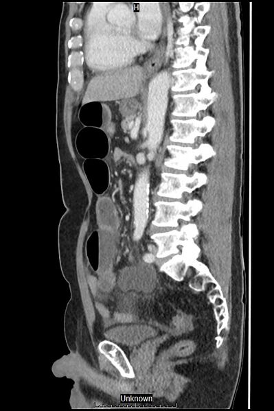 File:Closed loop bowel obstruction and ischemia (Radiopaedia 86959-103180 C 28).jpg